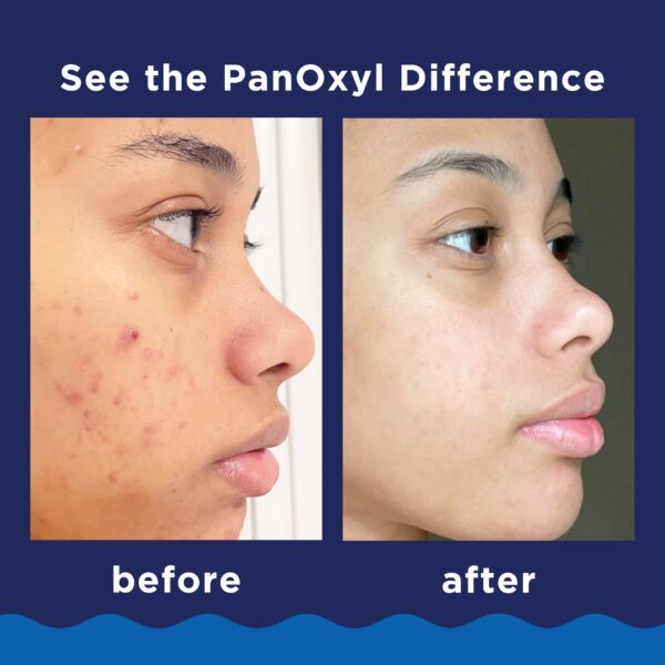 Acne Foaming Wash - Image 6